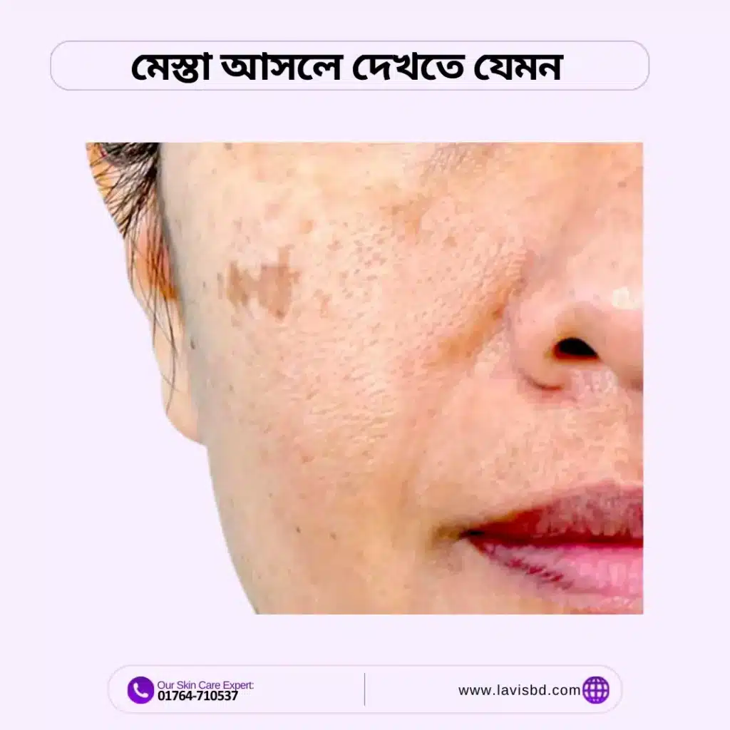melasma skin problem in bangladesh
glutathione melasma treatment
